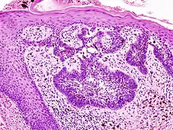Basal cell carcinoma of the skin, cell nuclei (blue-purple), extracellular material (pink)
