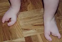 Oligodactyly, 2 toes on the feet of a one-year-old child