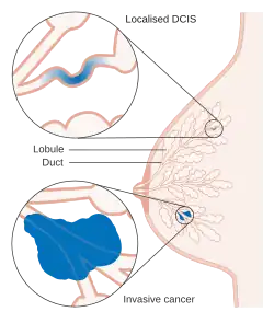 Diagram showing ductal carcinoma in situ (DCIS)[12]