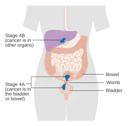 A diagram of stage IV endometrial cancer