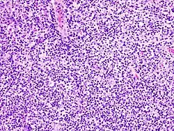 Histopathology of diffuse large B-cell lymphoma occurring in the tonsil. H&E stain.