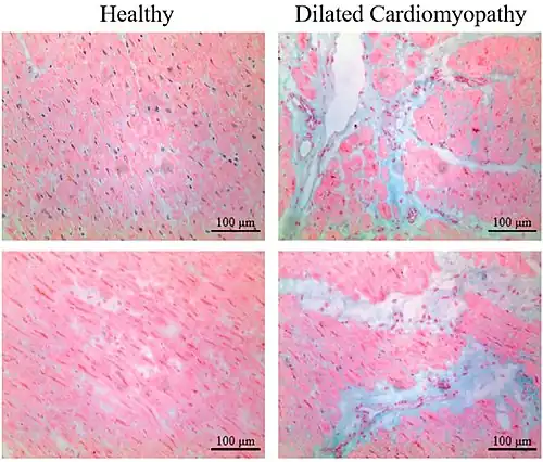 Micrograph of healthy myocardium versus interstitial fibrosis in dilated cardiomyopathy. Alcian blue stain. The fibrosis is either evenly distributed between myocytes or follows anatomic structures such as blood vessels.