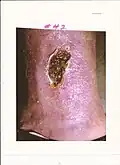 Intractable leg ulcer above the ankle healing after 42 DeMarco formula treatments