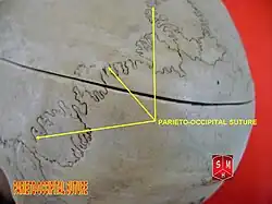 Lambdoid suture with Wormian bones, seen from behind.