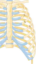 Illustration showing rib fracture at 3rd, 4th and 5th rib