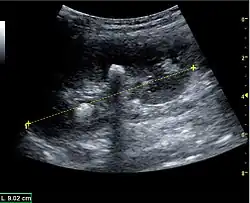 Figure 19. Centrally located stone with posterior shadowing. No hydronephrosis is present. Measurement of kidney length on the US image is illustrated by '+' and a dashed line.[1]