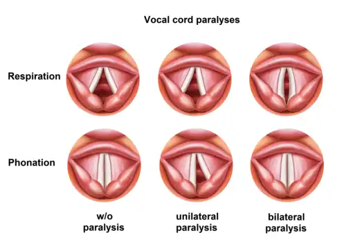 vocal cord positions regarding paralyses