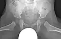 X-ray of the hips with a testicle shield