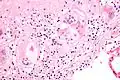 Micrografía de cuerpos de asteroides en sarcoidosis pulmonar. Tinción con hematoxilina eosina.