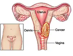 Cervical cancer