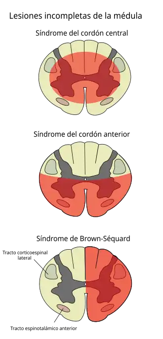 Lesiones incompletas de la médula
