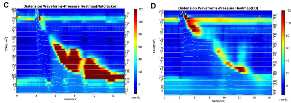 Disfagia funcional FD. Manometría esofágica de alta resolución.