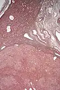 Micrografía de adenoma hepático. Impregnación argéntica.