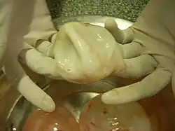 Apariencia de un quiste hidatídico al momento de su extirpación quirúrgica