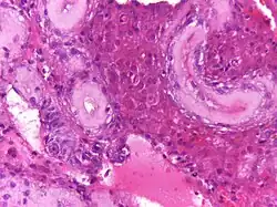 Imagen de una micrografía de tejido testicular mostrando hialinización y fibrosis de los túbulos seminíferos así como células de Leyding prominentes. Tinción de hematoxilina y eosina para contraste y apreciación de los compartimentos celulares.