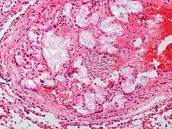 Celulosa microcristalina - Polarizada - Embolización pulmonar