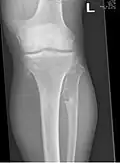 múltiples osteocondromas alrededor de la rodilla