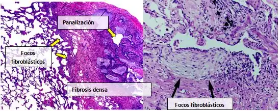 Microfotografía del aspecto histopatológico de la neumonía intersticial usual. El aumento de alta resolución (a la derecha) muestra un foco de proliferación de fibroblastos, cercana a un área de fibrosis dentro del cual puede observarse un infiltrado, leve y no específico, de células inflamatorias crónicas. En el espacio subpleural, puede reconocerse un aspecto típico de panal.