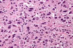 Pleomorphic undifferentiated sarcoma - very high mag