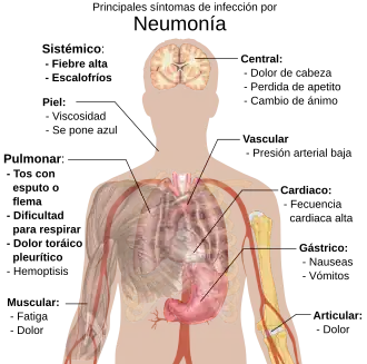 Principales síntomas de la neumonía infecciosa.