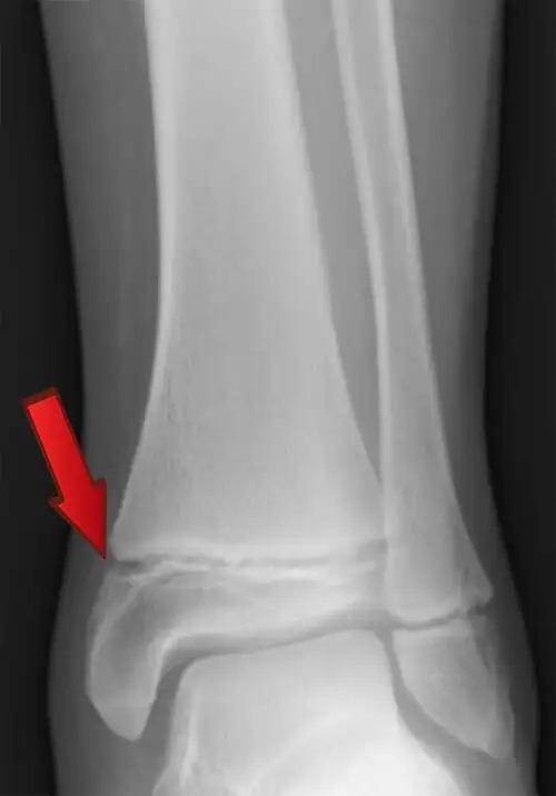 Radiografía. El disco de crecimiento se ve como un espacio transversal estrecho (flecha), atravesando el extremo inferior en una Tibia.