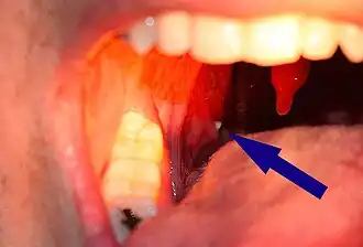 Un tonsilolito sobresale de la amígdala